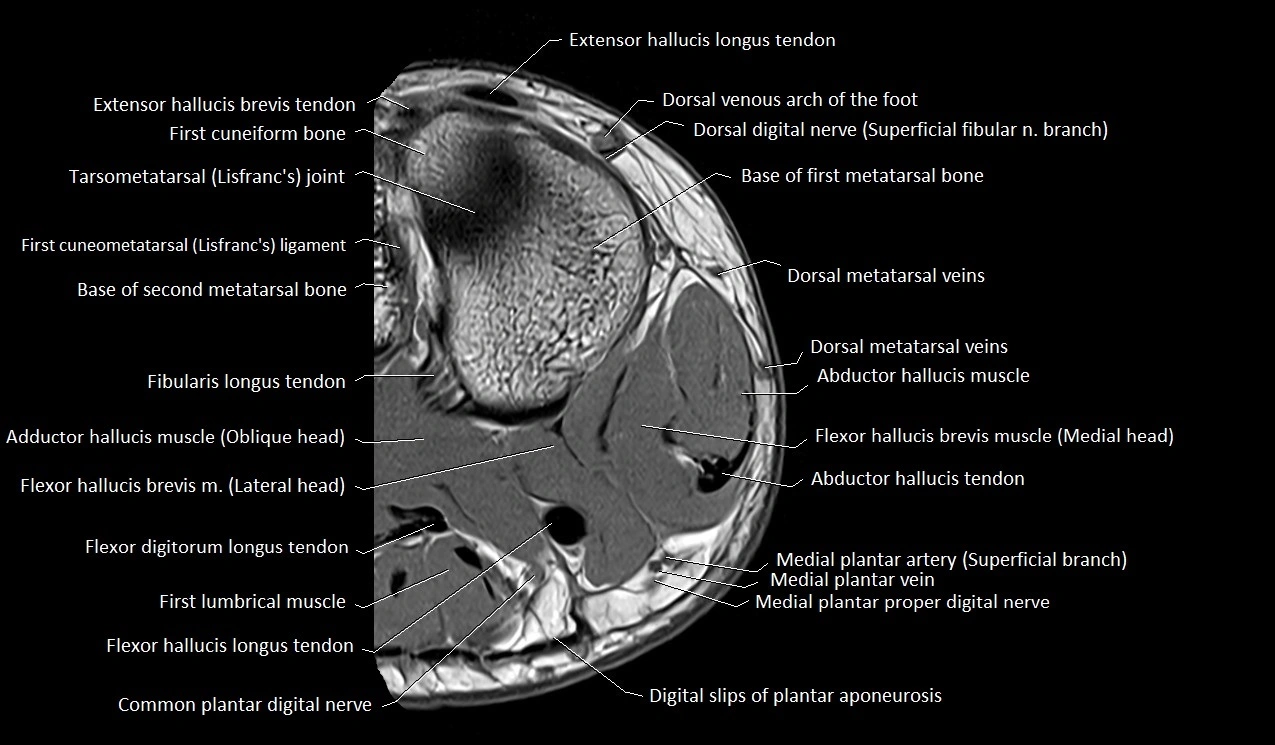 Great toe (hallux) axial microanatomy 3T MRI image 44.webp